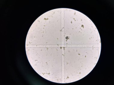 Calcium phosphate crystal in urine laboratory.