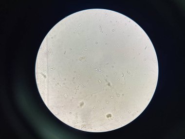 Budding yeast with pseudo hephae in urine laboratory.