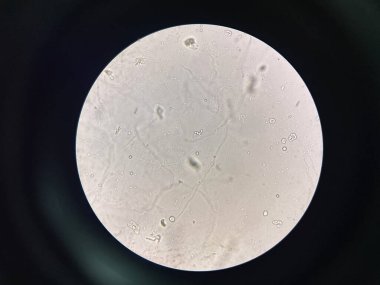 Budding yeast with pseudo hephae in urine laboratory.