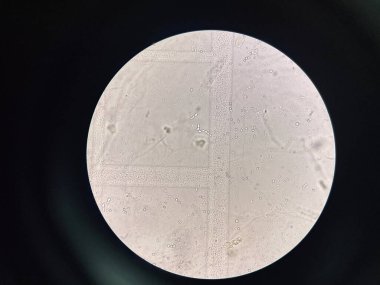 Budding yeast with pseudo hephae in urine laboratory.