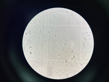 Budding yeast with pseudo hephae in urine laboratory.