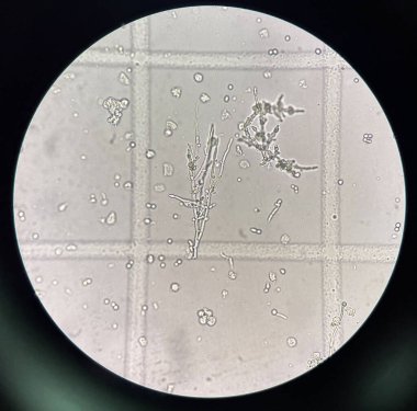 Budding yeast with pseudo hephae in urine laboratory.
