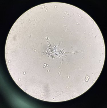 Budding yeast with pseudo hephae in urine laboratory.