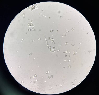 Budding yeast with pseudo hephae in urine laboratory.