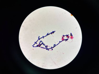 Budding yeast with pseudo hephae in urine Gram stain.