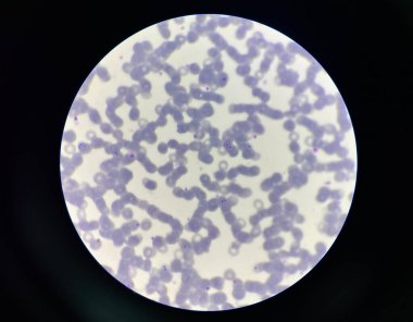 Malaria pigment blood parasite infected rbc.Thick film.