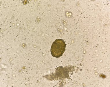 Ascaris lumbricoides  egg human parasite in stool examination.