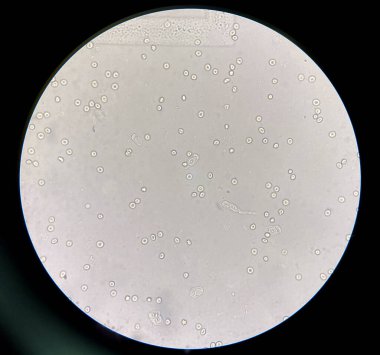 renal epithelial cell with rbc in Urine examination.