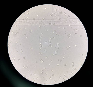 renal epithelial cell with rbc in Urine examination.