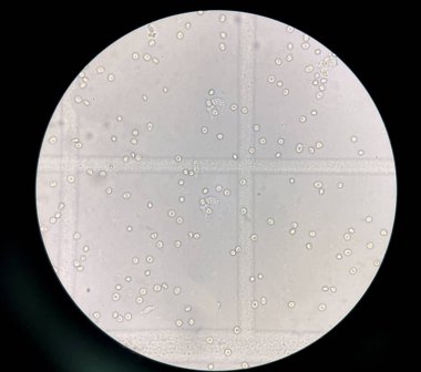 renal epithelial cell with rbc in Urine examination.