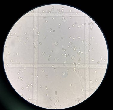 renal epithelial cell with rbc in Urine examination.