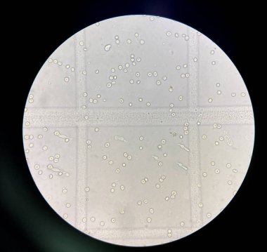 renal epithelial cell with rbc in Urine examination.