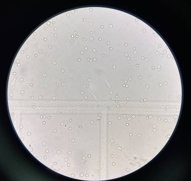 renal epithelial cell with rbc in Urine examination.