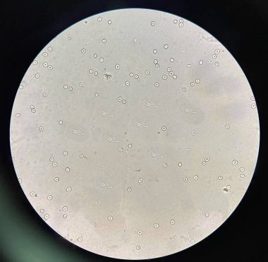 renal epithelial cell with rbc in Urine examination.