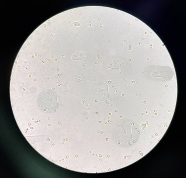renal epithelial cell with rbc in Urine examination.