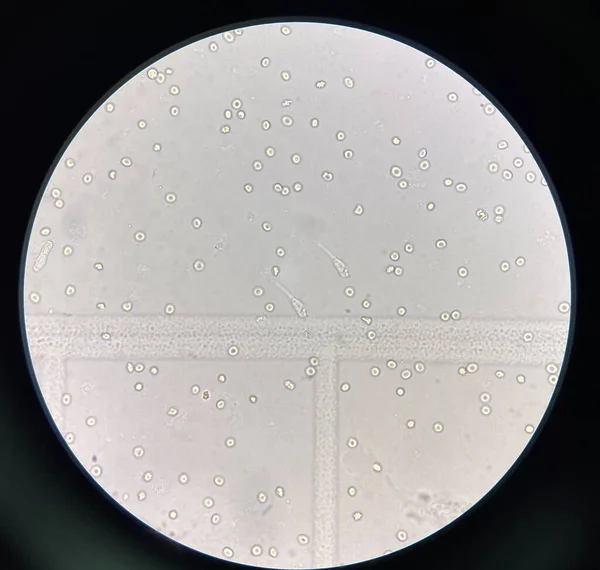 renal epithelial cell with rbc in Urine examination.