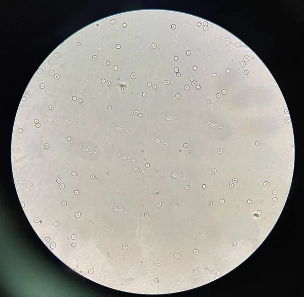 renal epithelial cell with rbc in Urine examination.