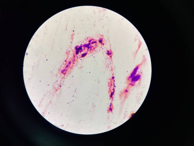 Mixed organism Bacteria cell in sputum sample Gram stain method.