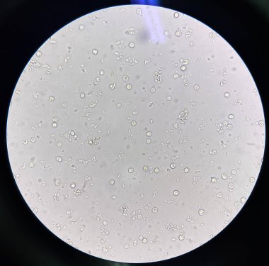 İdrarda beyaz kan hücresi idrar yolu enfeksiyonu olan bakteri hücresi..