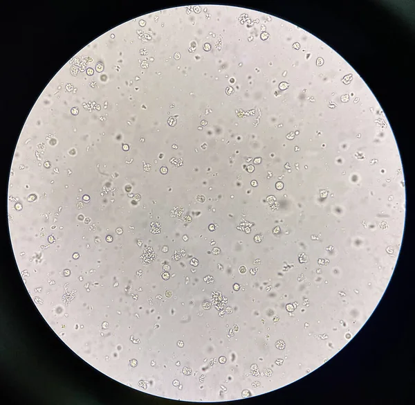 Cellules Bactériennes Dans Les Urines Avec Infection Des Voies Urinaires — Photo