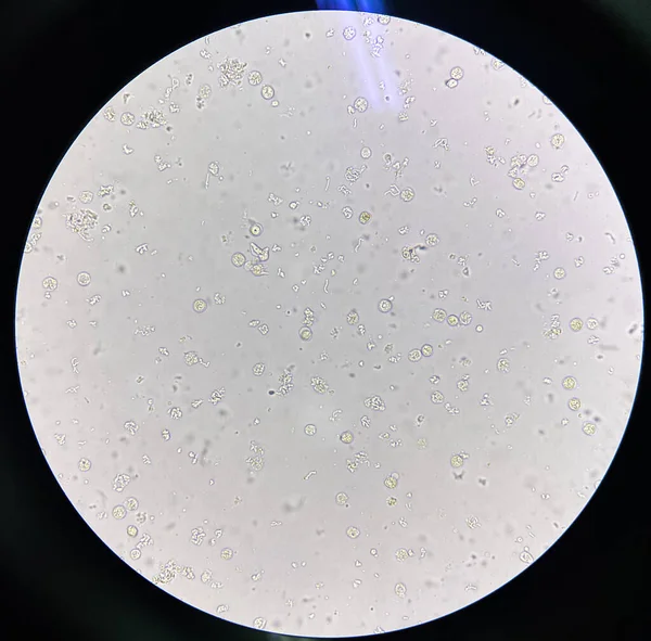 Бактерии Моче Инфекцией Мочевых Путей Белых Клеток Крови — стоковое фото
