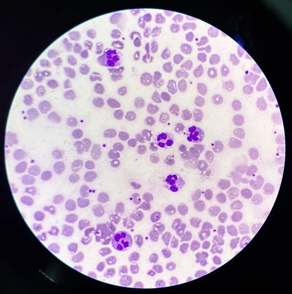 毒性の顆粒および液胞の炎症細胞を有する好中球 — ストック写真