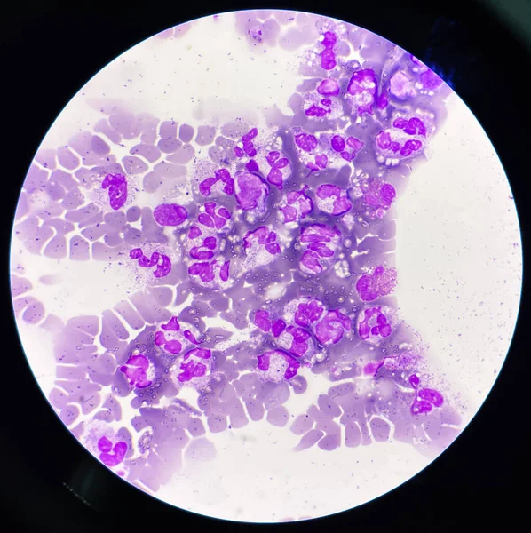 Neutrofil Toxikus Granulációval Vakuol Inframorikus Sejtekkel — Stock Fotó