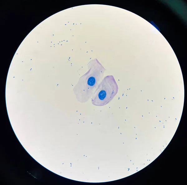 Cellula Epiteliale Squamosa Nell Espettorato Afb Negativo — Foto Stock