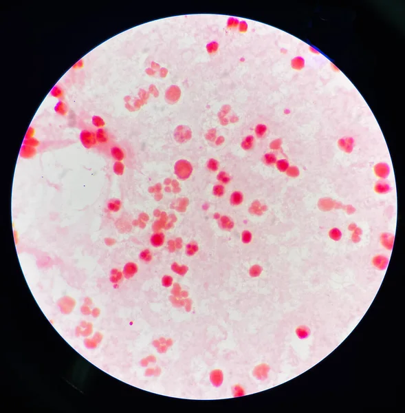 滑膜液次生细胞中的中性粒细胞 — 图库照片