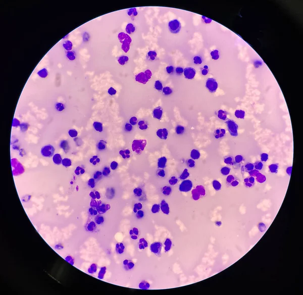 Mérsékelt Neutrofil Synovialis Folyadék Inframorális Sejtjeiben — Stock Fotó