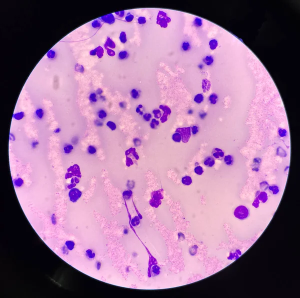 Mäßiges Neutrophil Inframatorischen Zellen Der Gelenkflüssigkeit — Stockfoto