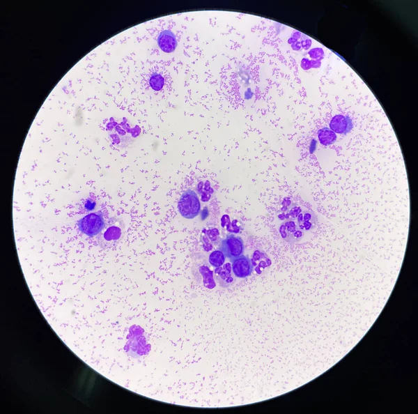 Středně Silný Neutrofil Inframatorních Buňkách Synoviální Tekutiny — Stock fotografie