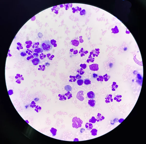 滑膜液次生细胞中的中性粒细胞 — 图库照片