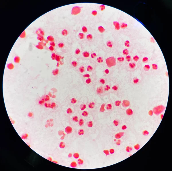 Mérsékelt Neutrofil Synovialis Folyadék Inframorális Sejtjeiben — Stock Fotó