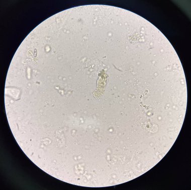 Tahta döküm mikroskop ile taze idrar bulguları.