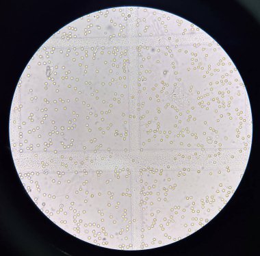 İdrar renal hasarı olan taze kırmızı kan hücresi..