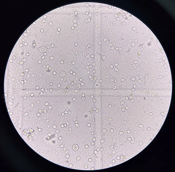 Microorganisme Globules Blancs Dans Urine Appareil Urinaire Dans Fection — Photo