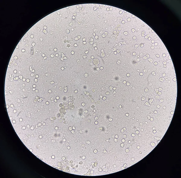 Microrganismo Globuli Bianchi Nell Urina Tratto Urinario Sezione — Foto Stock