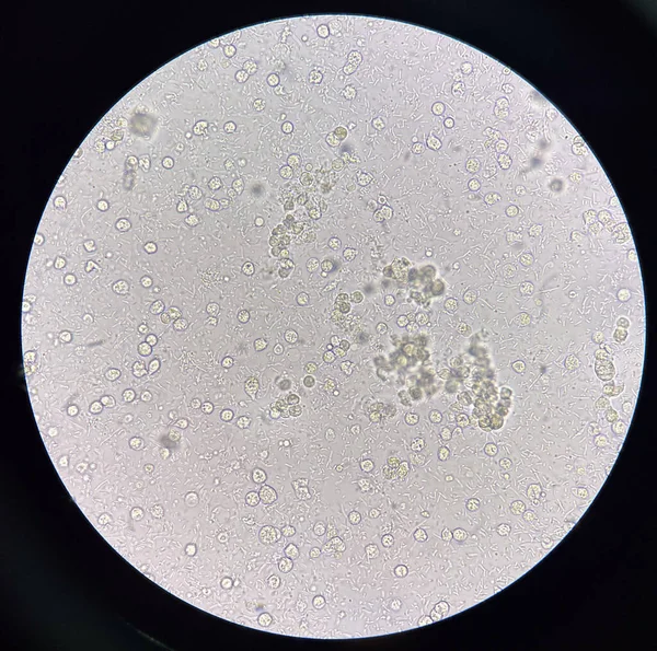 Mikroorganizmus Fehérvérsejt Vizeletben Húgyúti Fertőzés — Stock Fotó
