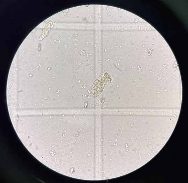 Kartong Gjuten Färsk Urin Fynd Med Mikroskop — Stockfoto