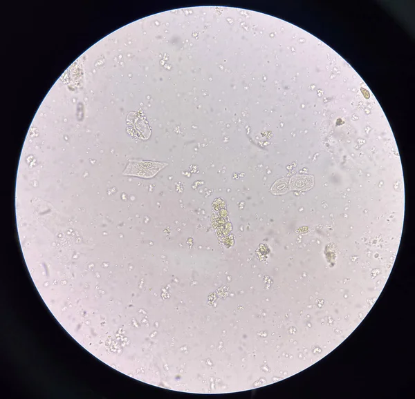 Planche Moulée Dans Urine Fraîche Découverte Microscope — Photo