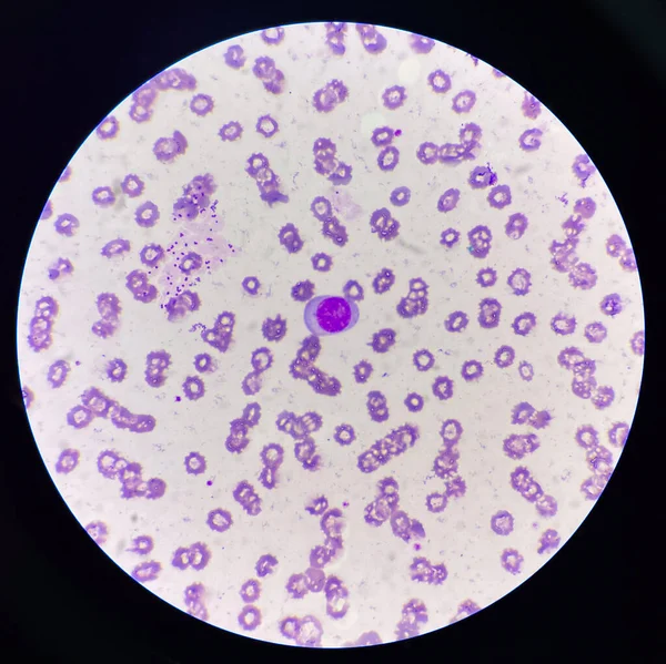Fehérvérsejtek Atipikus Lympho Cyta Vörösvértest Háttérben — Stock Fotó