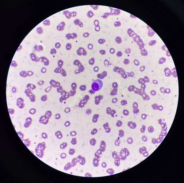 Λευκά Αιμοσφαίρια Ατυπη Λεμφοκύτταρα Φόντο Ερυθρών Αιμοσφαιρίων — Φωτογραφία Αρχείου