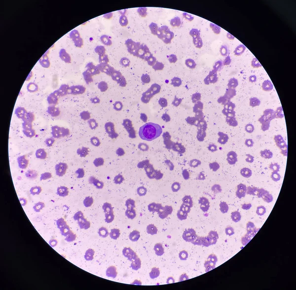 Bílé Krvinky Atypický Lymfocyt Pozadí Červených Krvinek — Stock fotografie