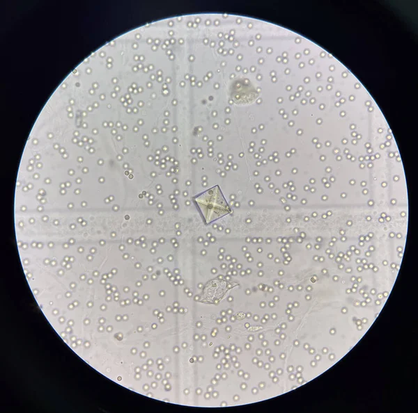 中红血球新鲜尿液中草酸钙晶体 — 图库照片
