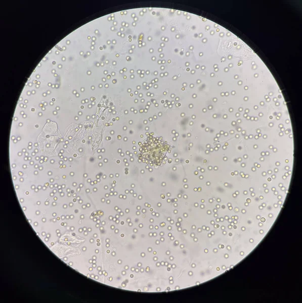 Kalsiyum Oksalat Kristali Taze Idrarda Orta Derecede Kırmızı Kan Hücresi — Stok fotoğraf
