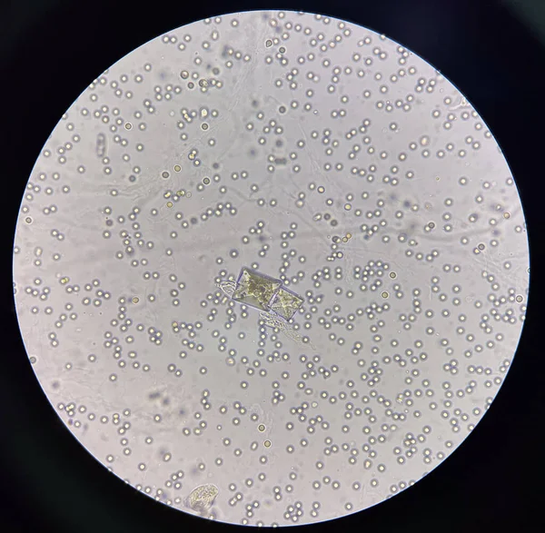 Calcium Oxalate Crystal Fresh Urine Moderate Red Blood Cell — Stock Photo, Image