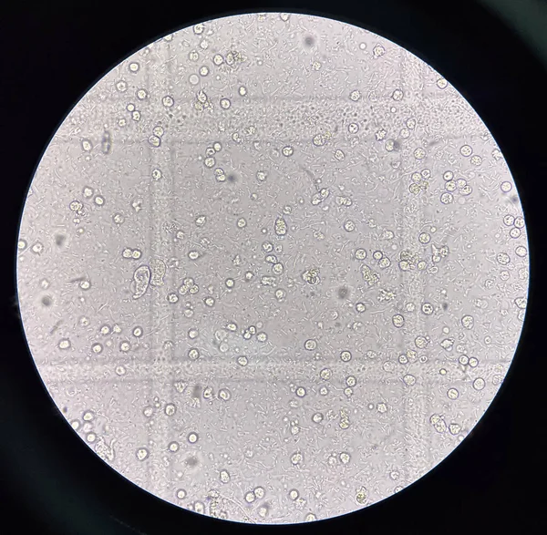 Microorganismo Glóbulos Blancos Orina Tracto Urinario Fección — Foto de Stock
