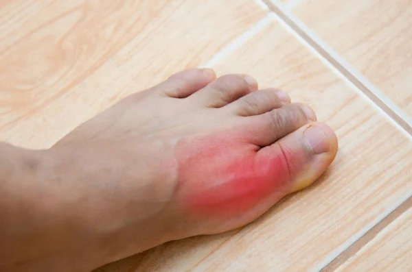Jicht Inflammatoire Artritis Dat Zeer Pijnlijk — Stockfoto