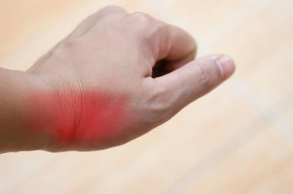 Arthrite Inflammatoire Goutte Qui Est Très Douloureuse — Photo